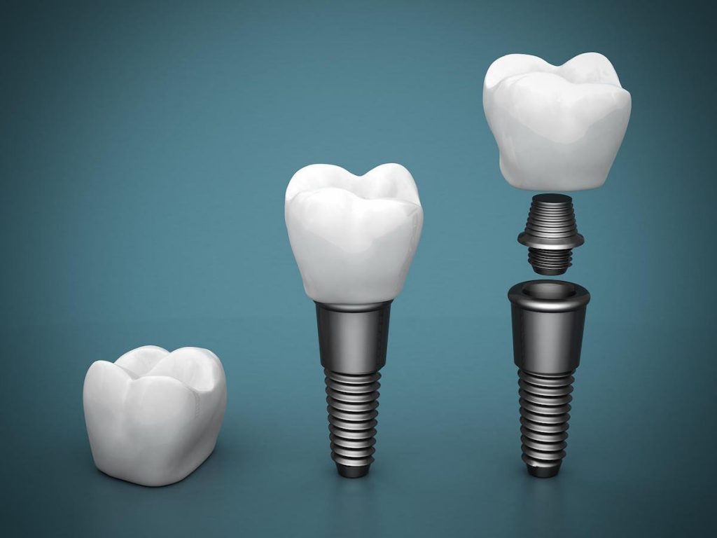 top 5 reasons dental implants are the best choice for replacing missing teeth in port macquarie