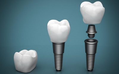 Are Dental Implants Best Choice for Replacing Missing Teeth?