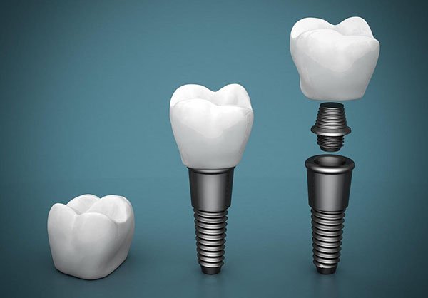 dental implants port macquarie