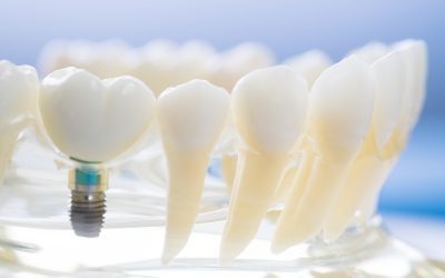 Dental Implants: Long-term Solutions to Missing Teeth