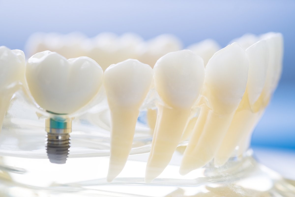 dental implants long-term solutions to missing teeth