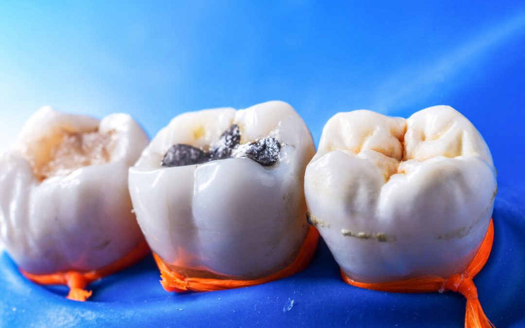 how to choose the best dental fillings in port macquarie