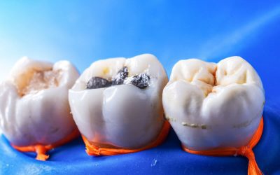 How to Choose the Best Dental Fillings in Port Macquarie