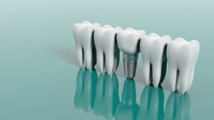 Cost Of Dental Implants In Australia images