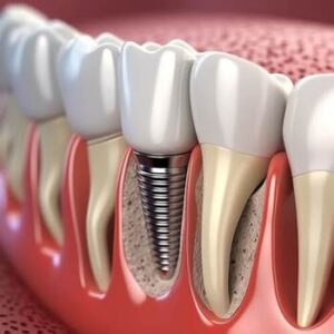 Single-Tooth-Implant-Cost-Australia-image