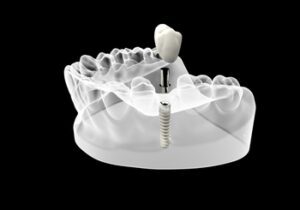 single-tooth-implant-cost-australia-illustration